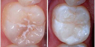 Best Dental Implant in Pimple Saudagar