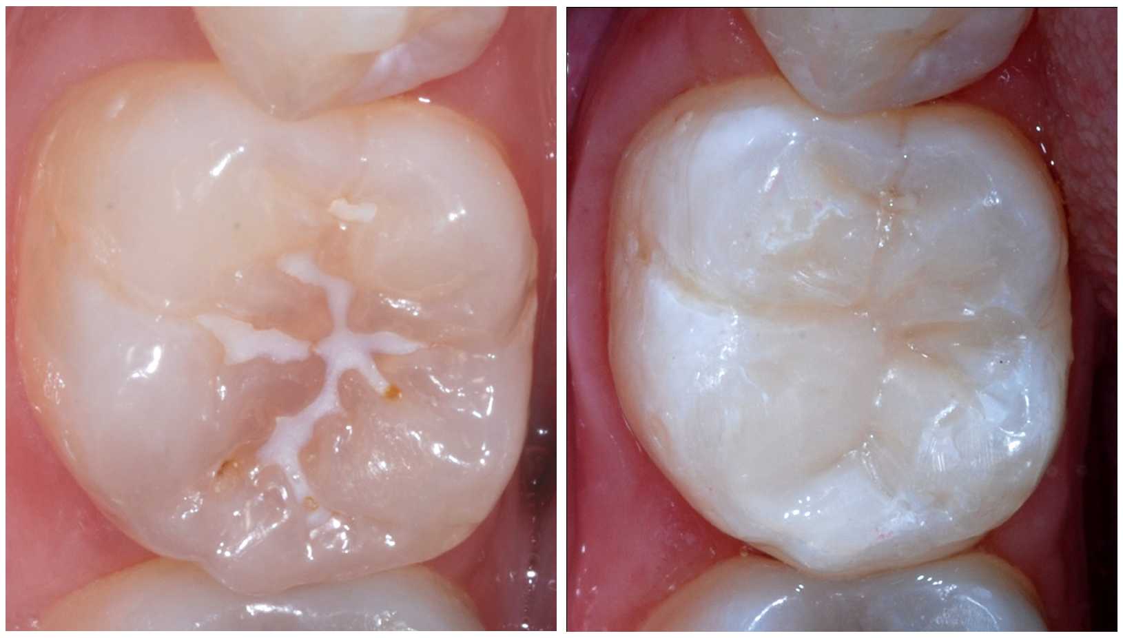 Best Dental Implant in Pimple Saudagar