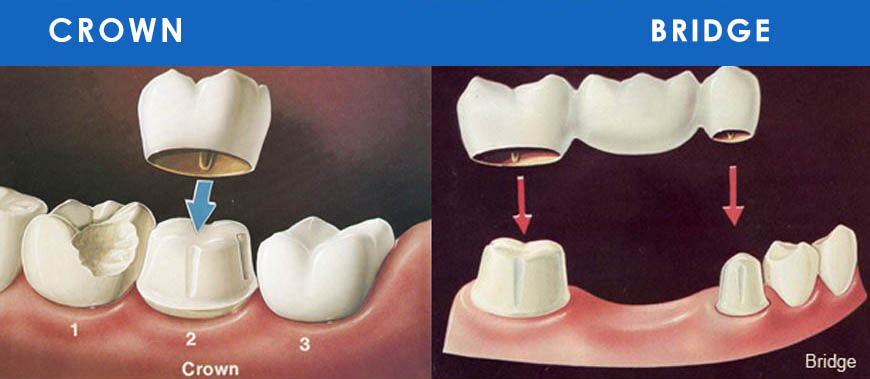 Bridges & Crowns Treatment