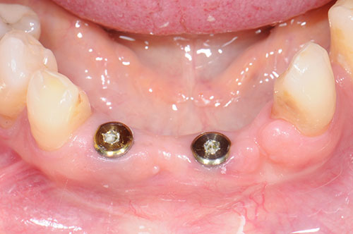 Best Dental Implant in Pimple Saudagar