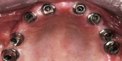 Best Dental Implant in Wakad