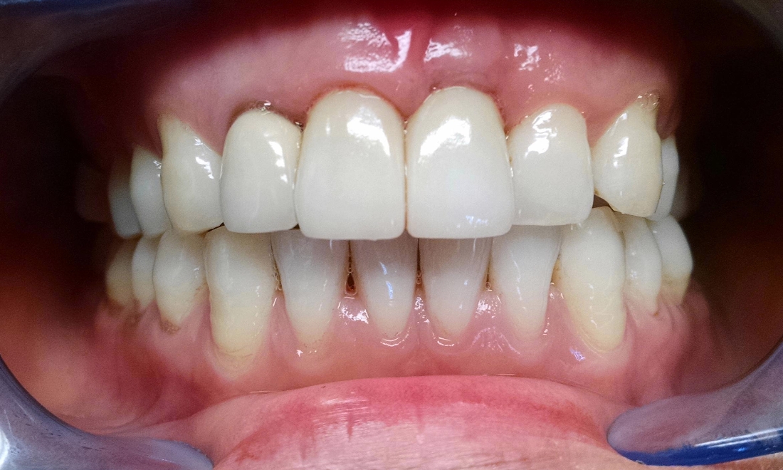 Best Dental Implant in Pimple Saudagar