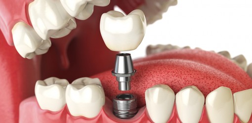 Best Dental Implant in Wakad