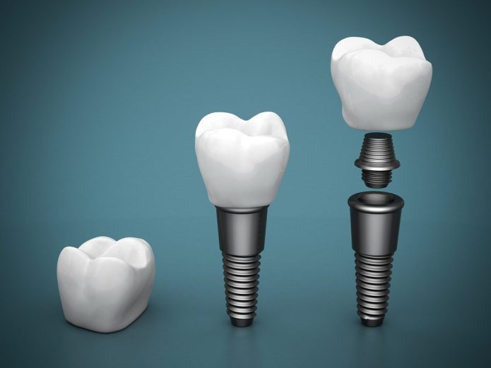 Best Dental Implant in Wakad