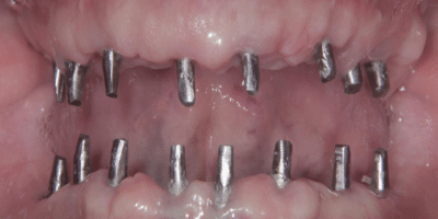 Best Dental Implant in Wakad