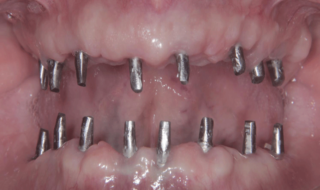 Best Dental Implant in Wakad