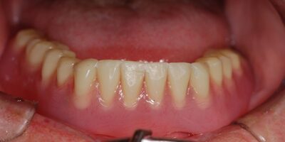 Best Dental Implant in Wakad