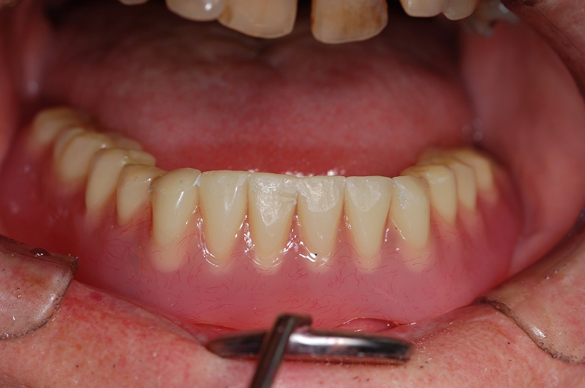 Best Dental Implant in Wakad