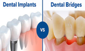 What is more suitable for me – Dental Implants or Bridge?