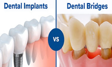 What is more suitable for me – Dental Implants or Bridge?